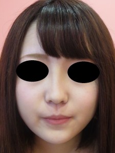 ①術後1ヶ月　正面